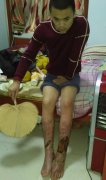 母子被怪病缠身数十年 脚发烫冬天都无法穿鞋
