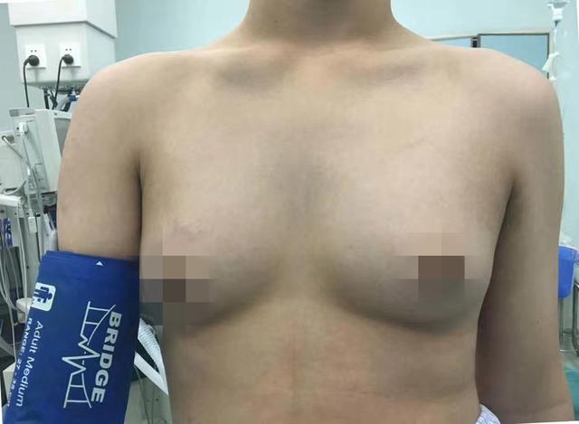 24岁小伙乳房越长越大 大学毕业胸围达115厘米
