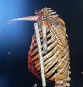 男子一个滑倒差点要命 老婆当场吓晕