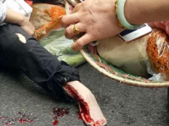 老太横穿马路 脚被公交车压得血肉模糊